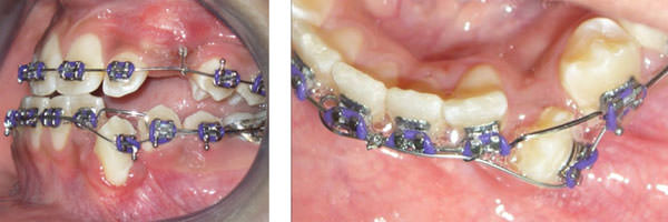Fig. 13 y 14 Fotografías intraorales de seguimiento, 15 meses de tratamiento.