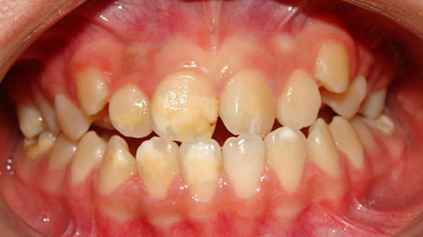 Figura 1 Opacidades en los incisivos y molares permanentes, paciente 1 (Clínica de la Especialidad en Endoperiodontología. FES Iztacala, UNAM).