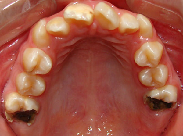 Figura 2 Fotografía oclusal del mismo paciente con hipomineralización severa, en la que se observa la destrucción de los molares afectados.