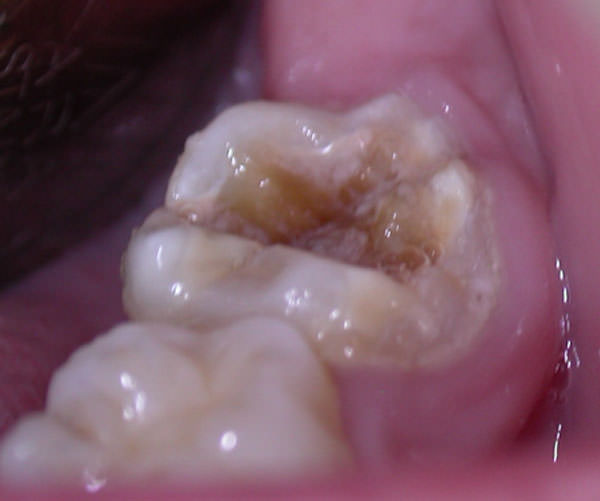 Figura 3 Molar con hipomineralización y una lesión de caries que retiene placa bacteriana. Paciente 2.