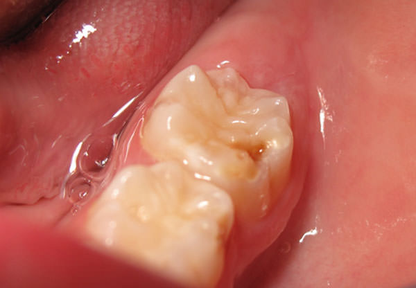 Figura 6 Primer molar permanente del paciente 3. Se observa junto a la cavidad, en la cara vestibular del primer molar permanente, una zona de hipomineralización. El paciente no reporta dolor, la dentina del fondo de la cavidad es firme y tiene buenos hábitos de limpieza oral y buen control de placa. El segundo molar deciduo también presenta una zona de hipomineralización en la cara vestibular