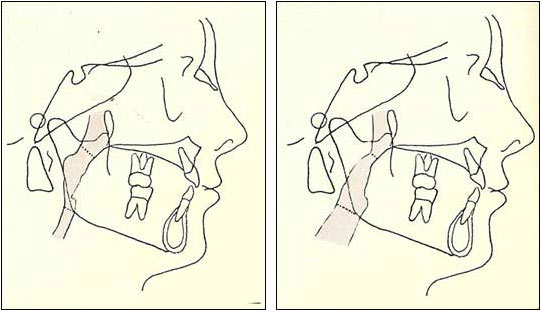 Tomado del libro Bases Biomecánicas y Aplicaciones Clínicas en Ortodoncia Interceptiva. Oscar Quirós A. 2006. Relación entre la Función Respiratoria y Morfología Facial