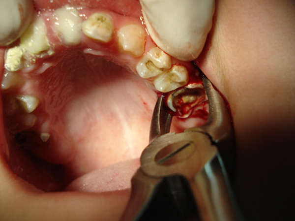 Foto 1 Estado del primer molar permanente derivado para extracción