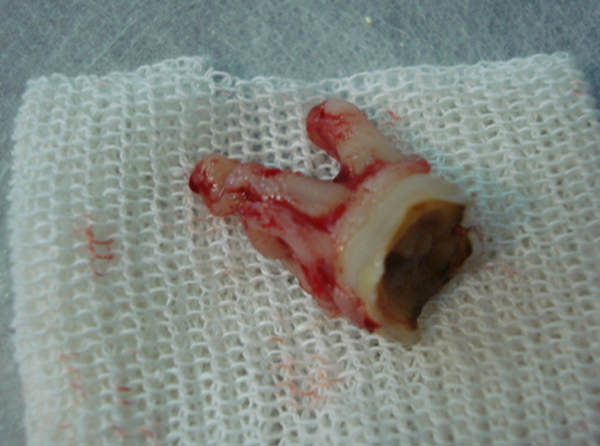 Foto 2 Primer molar permanente extraído
