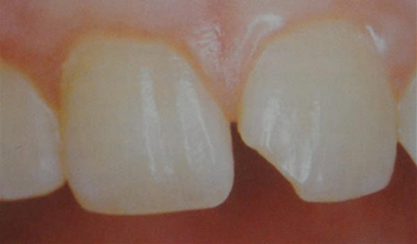 Fig. 3 Fractura no complicada de la corona que abarca el ángulo y borde mesial del 21. Fuente: Lanata, E. (2005). (11)