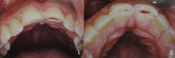 Fig. 4 1 - 2: Fracturas coronales complicadas en 11 y 21 con evidencia de exposición pulpar. Fuente: Andreasen, J & Cols. (2010) (6)