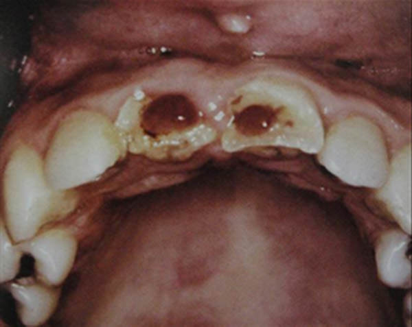 Fig. 5 Fractura coronal complicada con evidencia de proliferación pulpar 21 días luego del traumatismo. Fuente: Andreasen, J & Cols. (2010) (6)