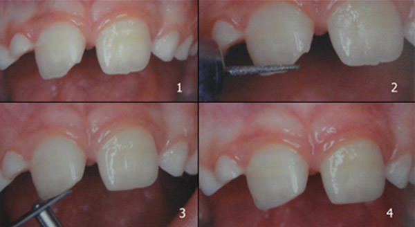 Fig. 6 Pulido del contorno de un incisivo con fractura en el esmalte. 1: Las irregularidades de los márgenes incisales se pueden tratar con pulido de los bordes. 2: Se contornean los márgenes con una piedra de diamante. 3: Se alisa con un disco de pulido a baja velocidad. 4: Imagen final del remodelado de una fractura no complicada en esmalte. Fuente: García C, Mendoza, A. (2003) (2)