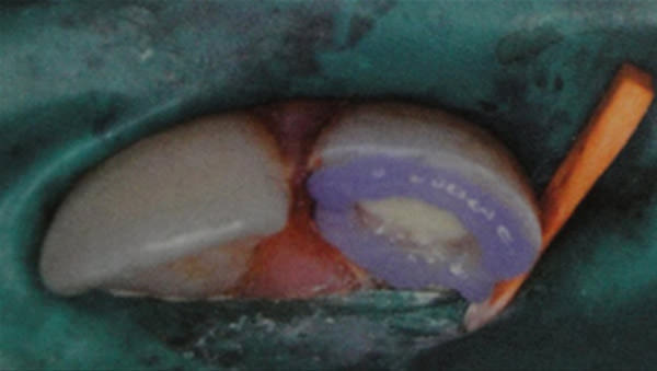 Fig. 7 Grabado ácido de esmalte y dentina. Fuente: García C, Mendoza, A. (2003) (2)