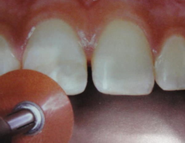 Fig. 11 Acabado de la superficie vestibular reforzada con resina compuesta. Fuente: Andreasen, J & Cols. (2010) (6)