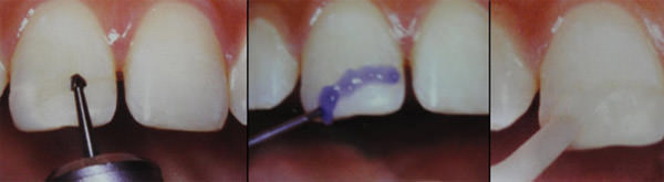 Fig. 10 Reforzamiento del aspecto vestibular con resina compuesta luego de realizar un margen en forma de chaflán en la línea de fractura. Fuente: Andreasen, J & Cols. (2010) (6)