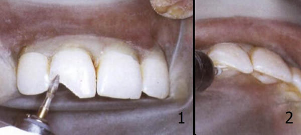 Fig.13 Preparación del chaflán: 1: Chaflán vestibular. 2: Chaflán palatino. Fuente: Andreasen, J. & Cols. (2000). (26)