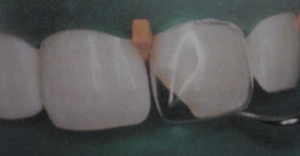 Fig. 14 Utilización de matrices comerciales de acetato de celuloide. Fuente: Lanata, E (2005).(11)