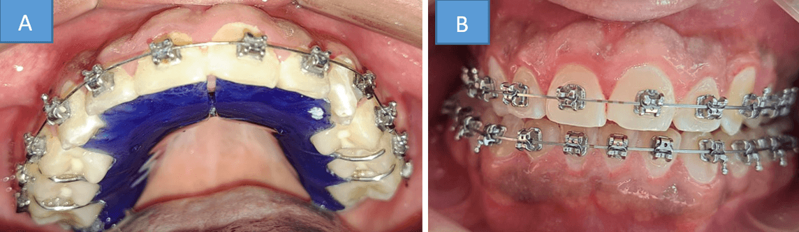 Fig. 4: A)Placa activa con tornillo de expansión B) seguimiento
