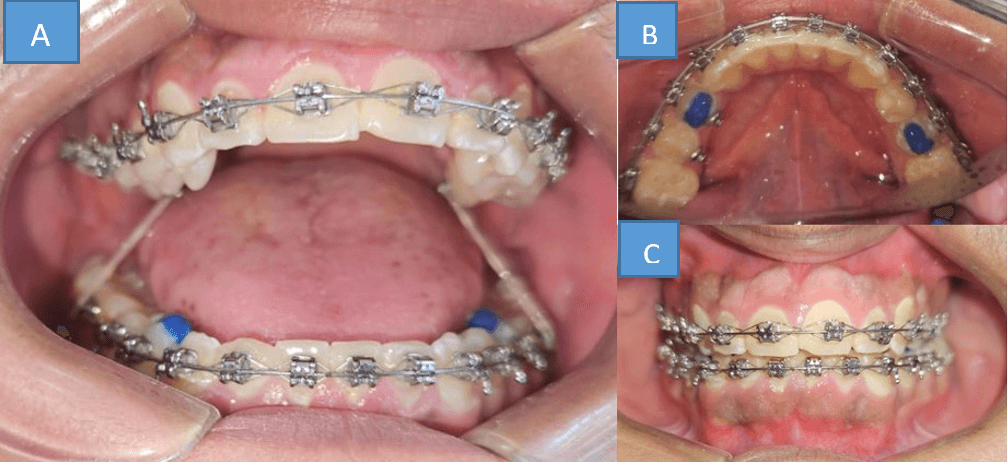 Fig. 5: A) elásticos intermaxilares B) Topes oclusales C) Descruzo lado derecho