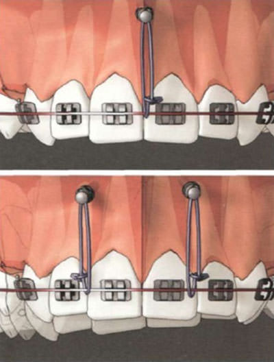 Figura 1. (Sung J, Alvarez A, Mcnamara J. Microimplantes en Ortodoncia)