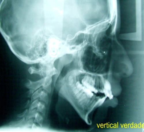 Figura 6 Radiografía Lateral