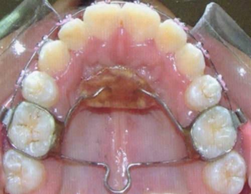 Fig 8 Oclusal superior