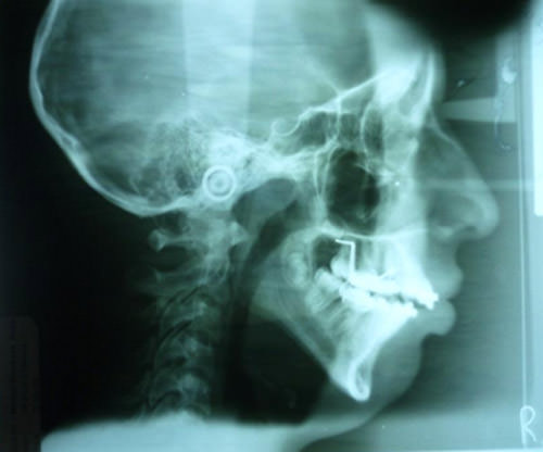 Fig. 11 Radiografía lateral de cráneo