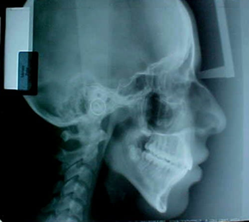 Fig. 17 Radiografía lateral de cráneo