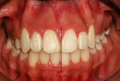 Fig. 18 Intraoral de frente donde vemos la línea media coincidente
