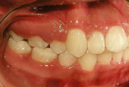 Fig 19 Intraoral derecha