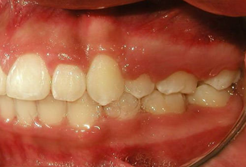 Fig 20 Intraoral izquierda