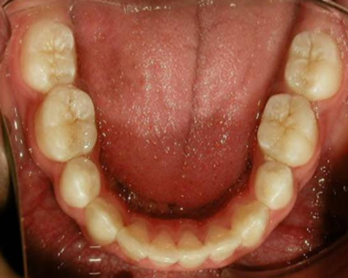 Fig. 22 Oclusal Inferior