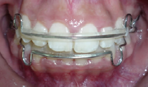 Fig. 23 Intraoral de frente retenedores