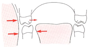 Fig. 1 Representación esquemática de las presiones de los tejidos blandos en la región de los molares en un niño con hábito de chuparse el dedo. Al descender la lengua y contraer las mejillas durante la succión, se altera el equilibrio de presiones que actúan sobre los dientes superiores y los molares superiores se desplazan lingualmente, pero no así los molares inferiores.
