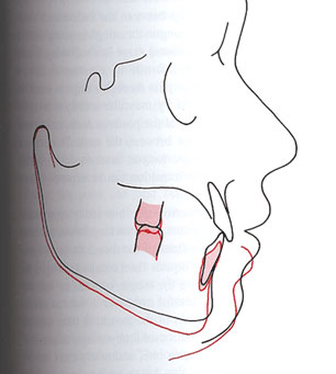 Fig. 2 Registro Cefalométrico que muestran los efectos de la erupción posterior sobre el grado de la apertura anterior. La única diferencia entre los trazos rojos y negros consiste en los primeros molares se han alargado 2mm en el trazado rojo. Se puede observar que el resultado es una separación de 4mm entre los incisivos, debido a la geometría de la mandíbula.