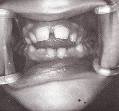 Fig. 3 Aspecto típico de la deglución con protrusión lingual con la punta de la lengua colocada entre los incisivos y proyectándose hacia delante para contactar con el labio inferior elevado.
