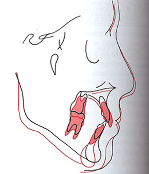 Fig. 4 Cefalometria de un paciente que experimenta un significado crecimiento maxilar vertical.