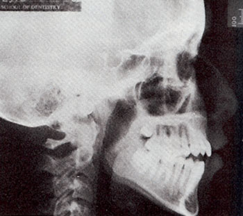 Fig. 5 Mordida abierta anterior de una muchacha de 13 años