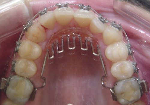 Fig. 6 Rejilla Lingual