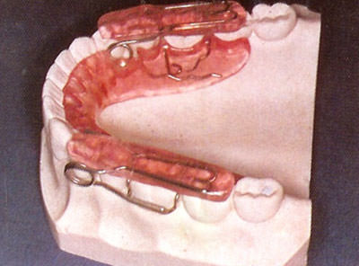 Fig. 8 Bloque de intrusión posterior
