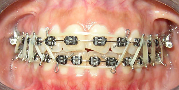 Fig.9 Elásticas Intermaxilares