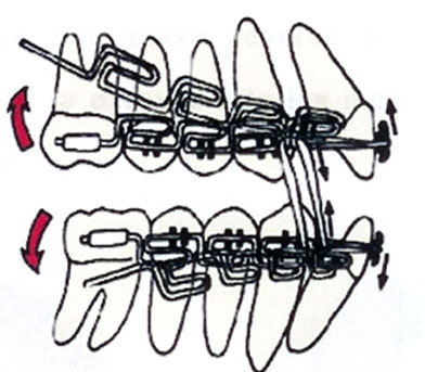 Fig. 10 Arcos multiloop de edgewiswe