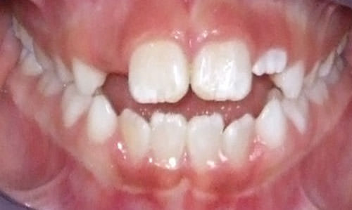 Fig.4 Fotografía oclusal de frente corrobora mordida abierta. Estudio de modelos: se tomaron los modelos iniciales al paciente.