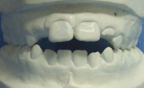 Fig. 5 Modelo inicial de estudio se corrobora la mordida abierta anterior