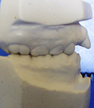 Fig. 6 Modelo inicial de estudio donde se observa incisivos superiores protruidos.