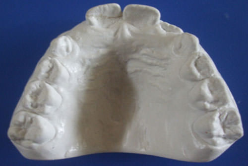 Fig. 7 Modelo arcada superior