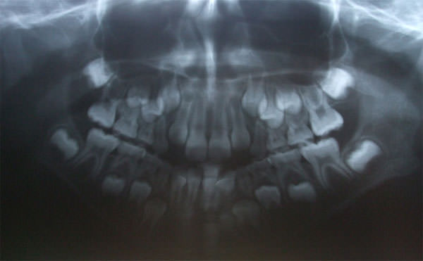 Fig. 9 Radiografía panorámica se observa la falta de contacto anterior