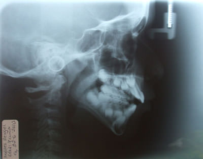 Fig. 10 Radiografía Cefálica Lateral