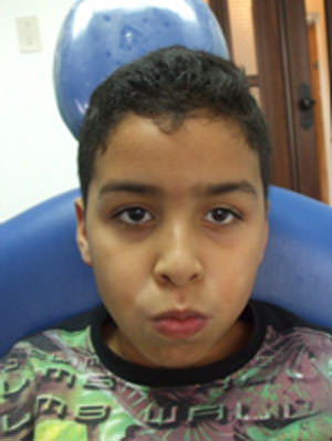 Fig. 13 Paciente con aparato en boca y sellado labial