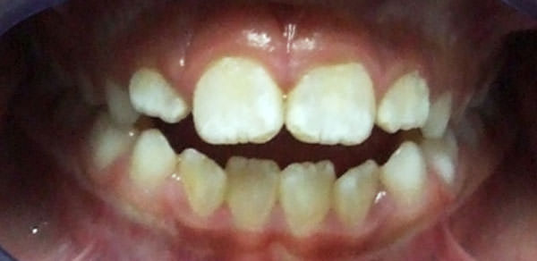Fig. 16 Fotografía frontal a los 2 meses de instalado el aparato y mes y medio Indicada la terapia miofuncional.