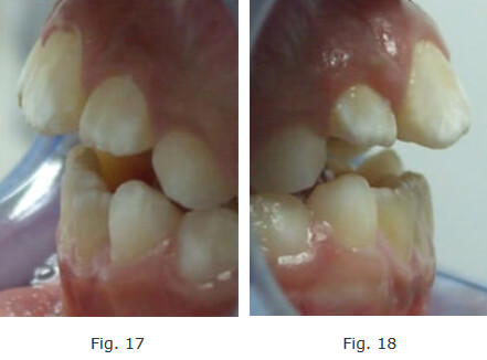 Fotografías laterales a los 2 meses de instalado el aparato y mes y medio Indicada la terapia miofuncional.