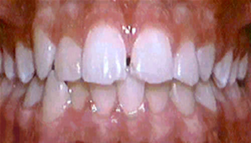 Fig. 1 Caso para extracción de un incisivo central inferior. Vista frontal.