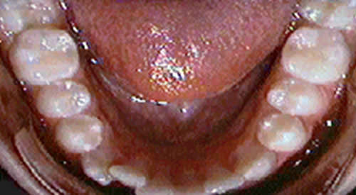 Fig. 2 Vista oclusal