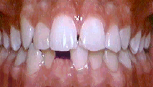 Fig. 3 Extracción del incisivo Inferior derecho